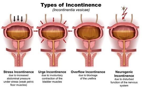 incontinenza urinaria femminile - pavimento pelvico - ostetrica indipendente - roma tivoli guidonia